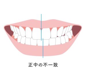 札幌　矯正　歯並び