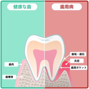 歯周病　歯周組織