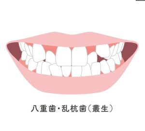 札幌　矯正歯科　歯列矯正　八重歯　叢生　