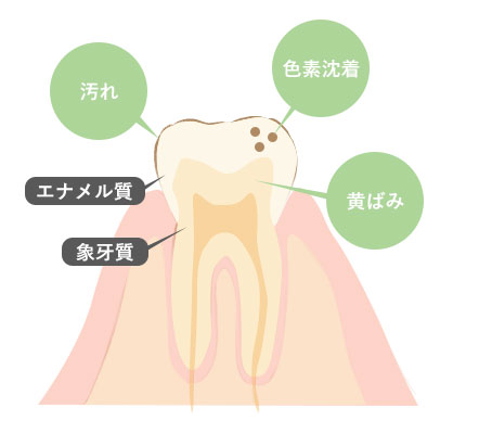 歯が黄ばむ原因
