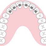 部分矯正　歯列矯正