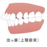 出っ歯　上顎前突