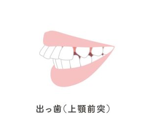 札幌　歯列矯正　矯正歯科　出っ歯　上顎前突