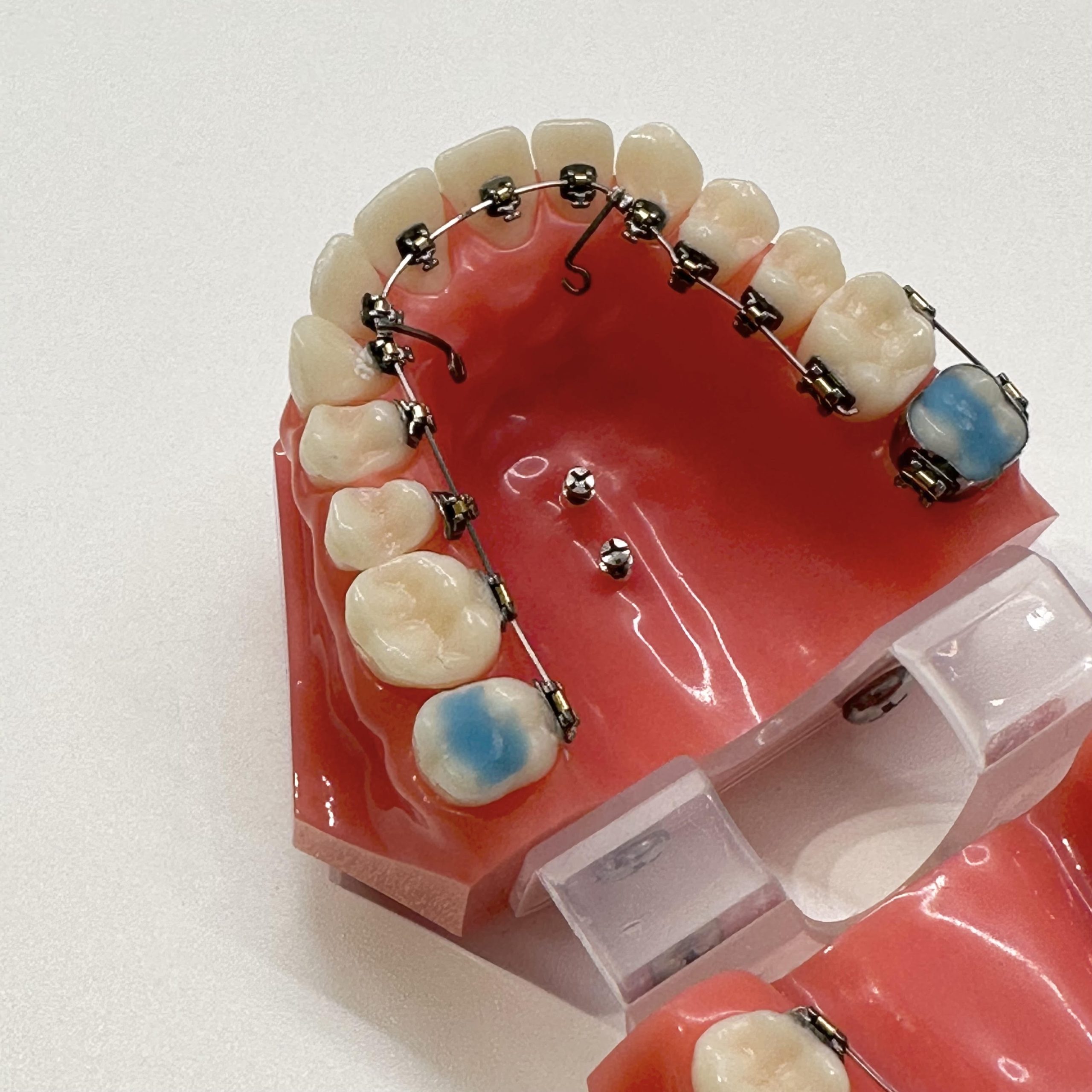 目立たない矯正治療・裏側矯正で治せるのはどんな歯並び？ | 札幌