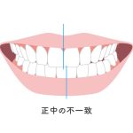 正中の不一致　歯並び