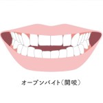開咬　オープンバイト