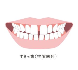札幌　矯正　歯列矯正　すきっ歯　空隙歯列　