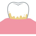 歯垢　プラーク　汚れ