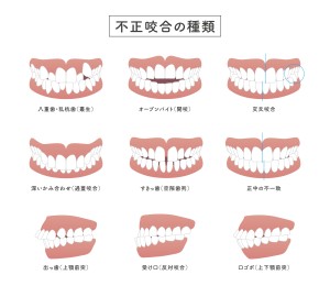 不正咬合　歯列不正