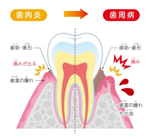 札幌　歯列矯正　矯正歯科　歯周病