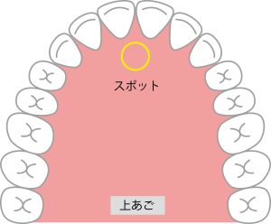 札幌　矯正歯科　歯列矯正　舌の位置　スポット　
