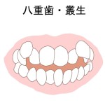 八重歯　叢生　不正咬合