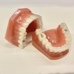 マウスピース矯正