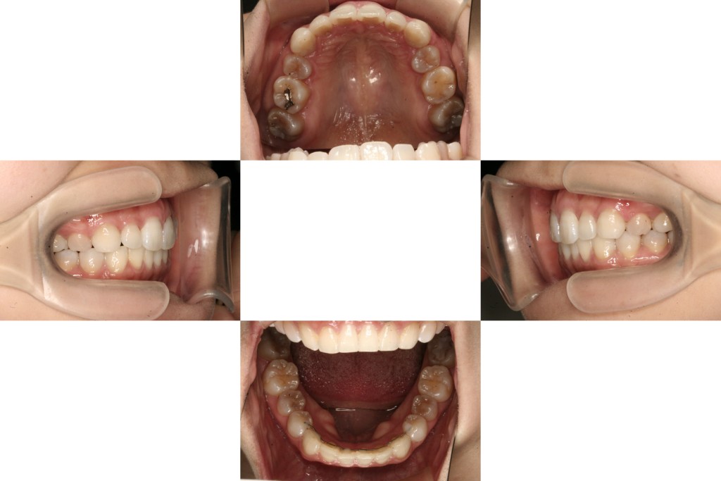 case13_軽度の出っ歯_2年半