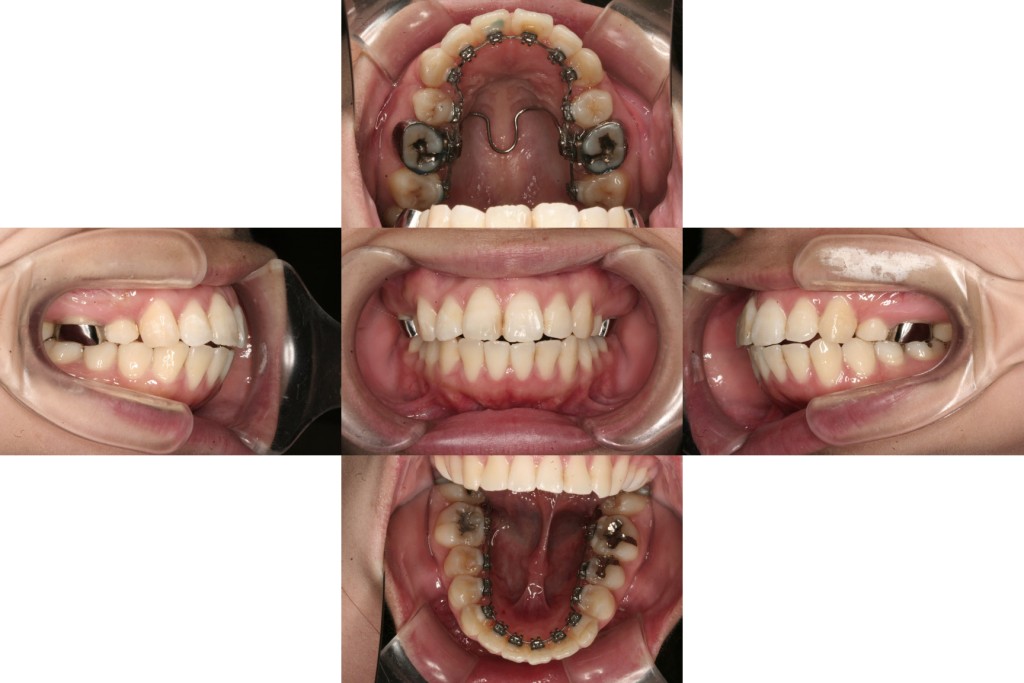case14_出っ歯_1年半