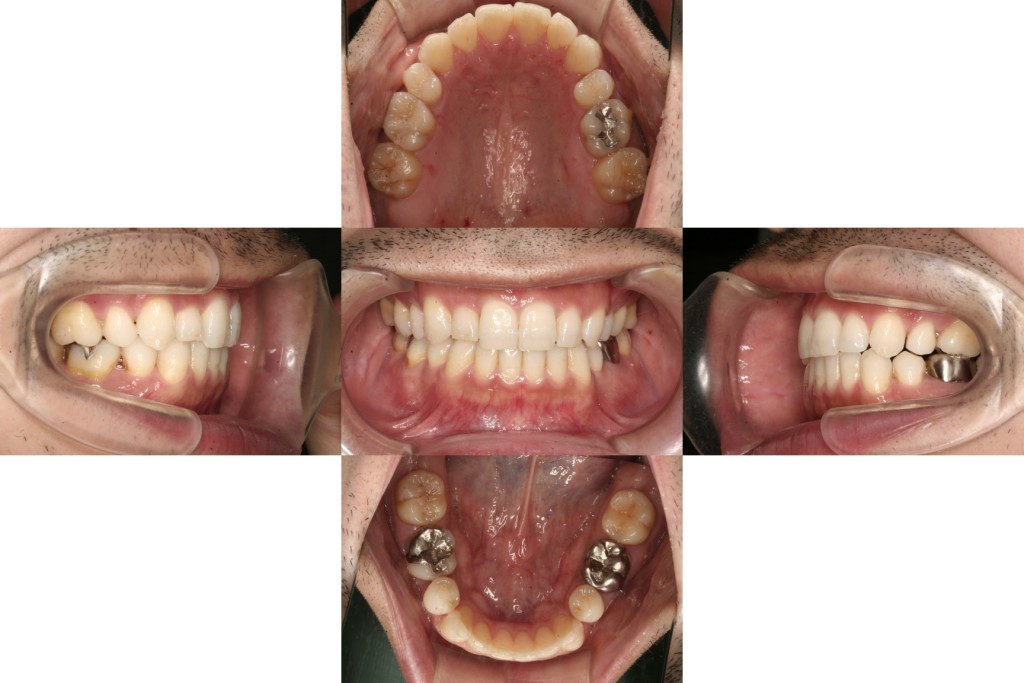 case23_歯の凹凸_2年9か月