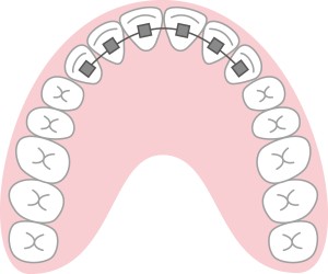 部分矯正　前歯　歯列　