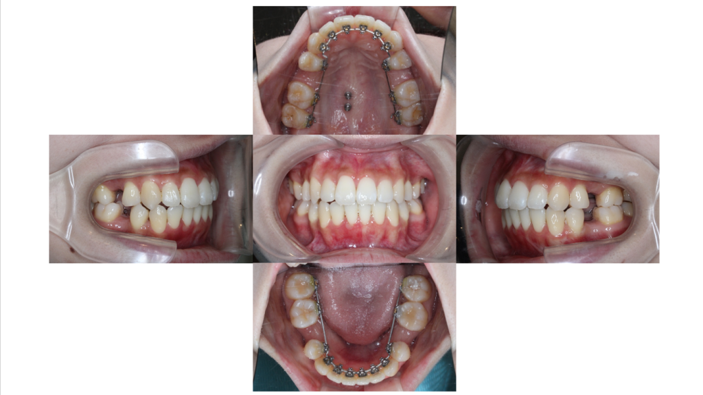 叢生・裏側全体矯正の症例