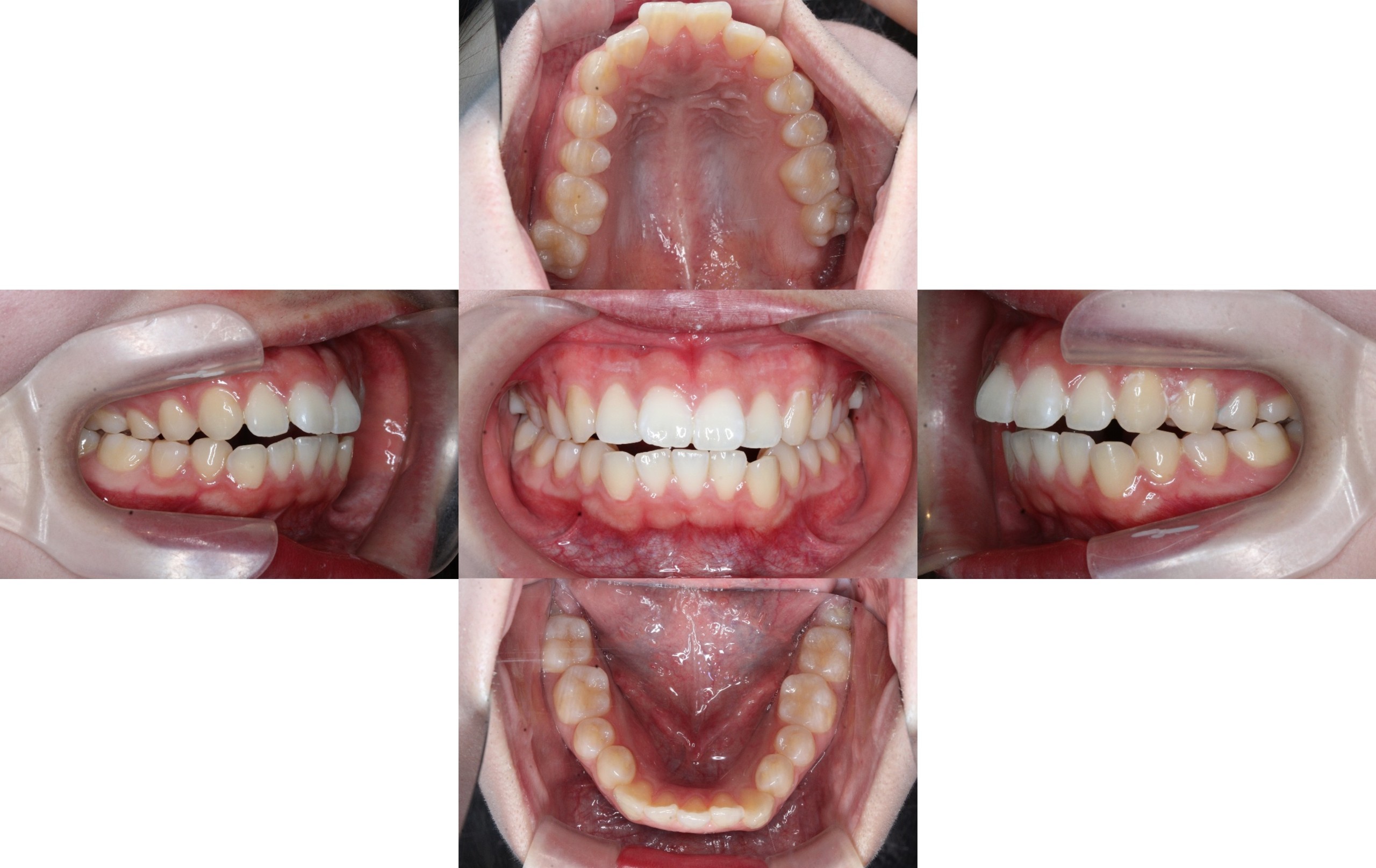 裏側矯正　上顎前突　開咬症例