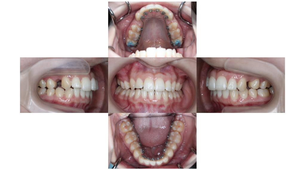 裏側矯正・叢生の症例