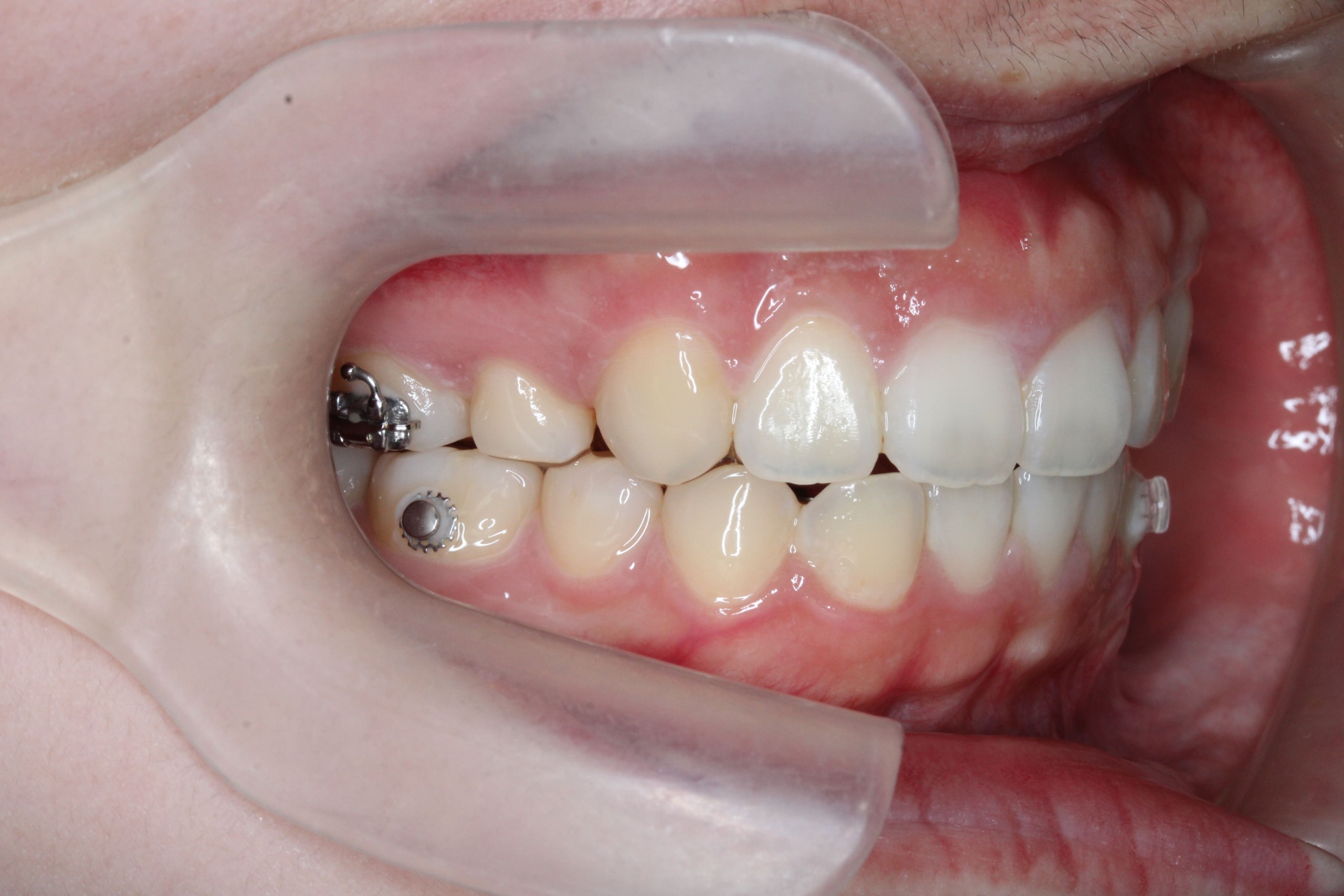 裏側矯正　上顎前突　開咬症例