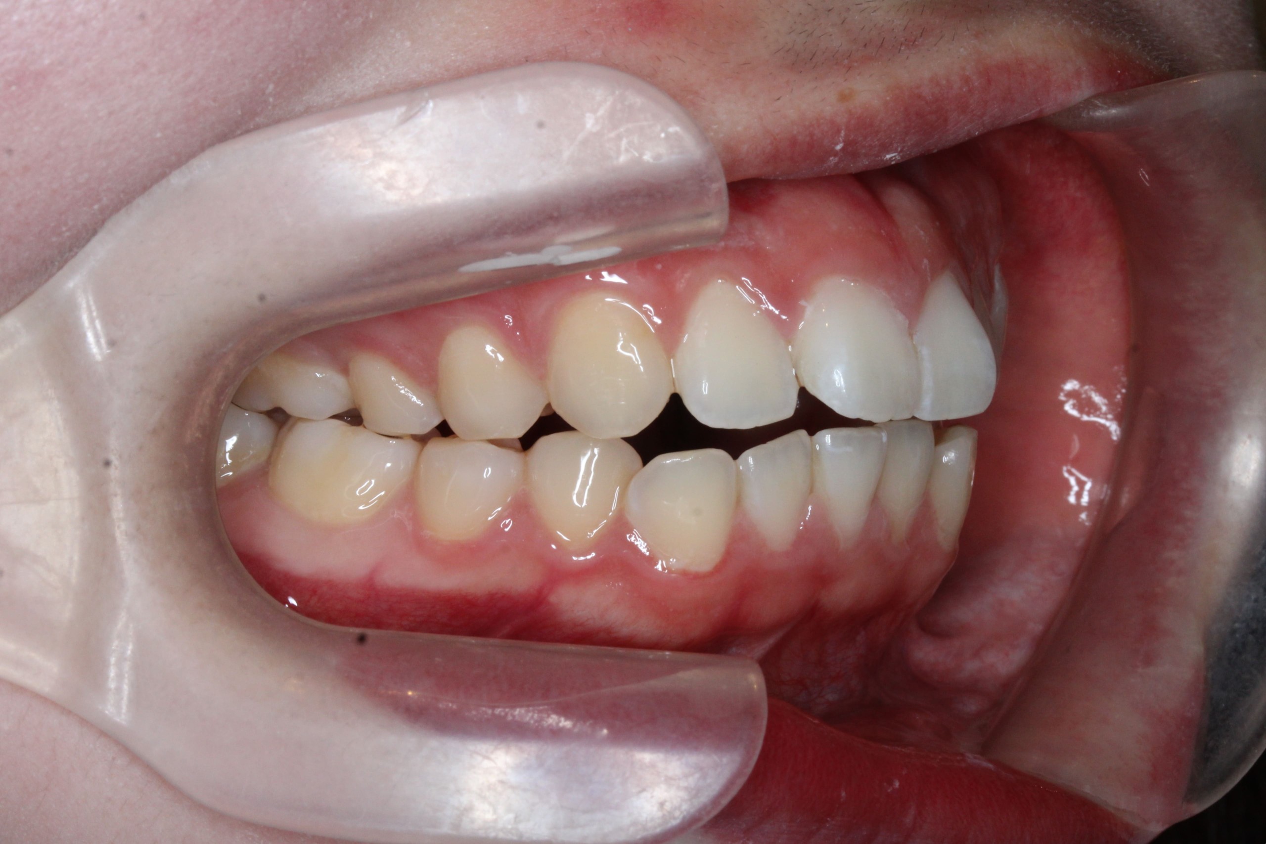 裏側矯正　上顎前突　開咬症例