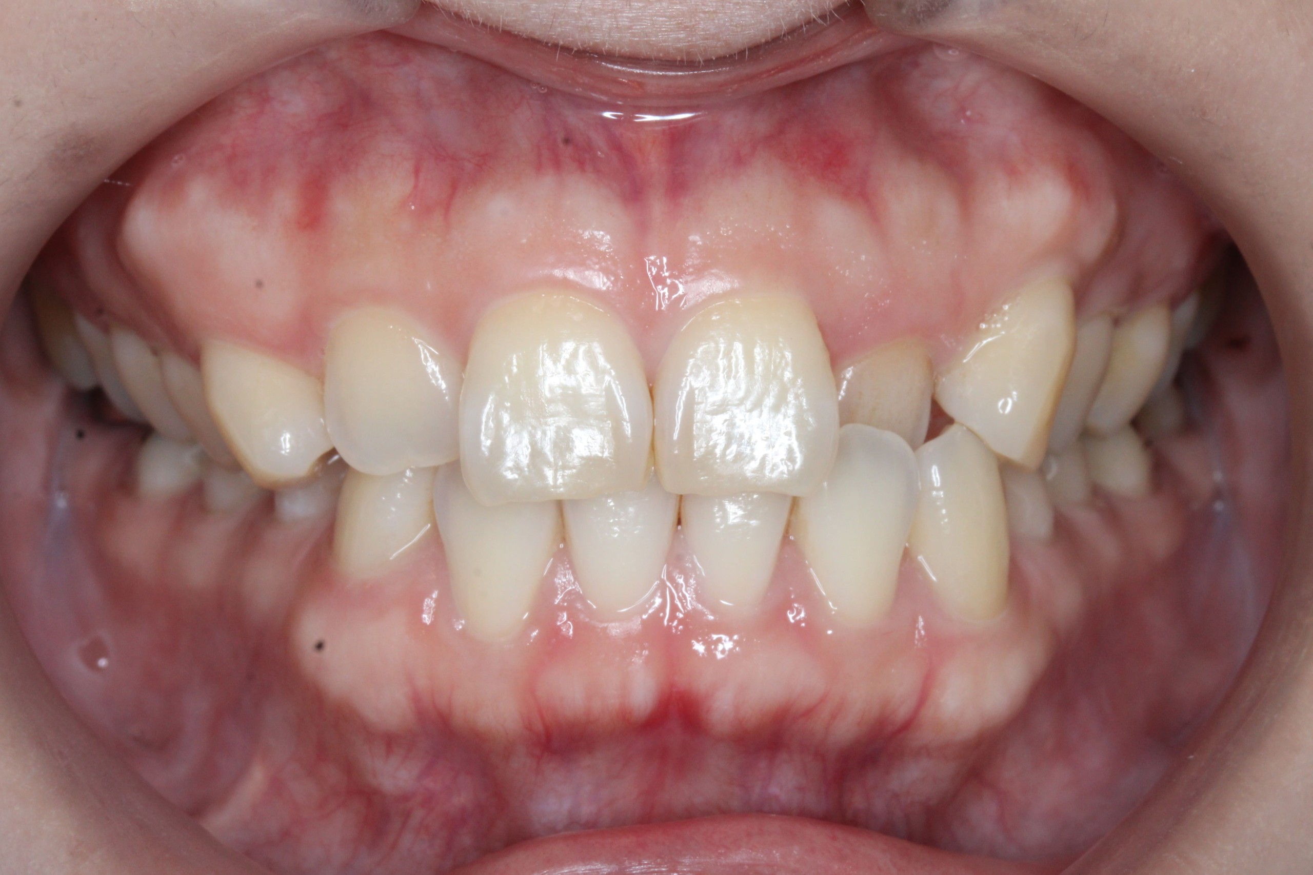 ハーフリンガル矯正　叢生症例