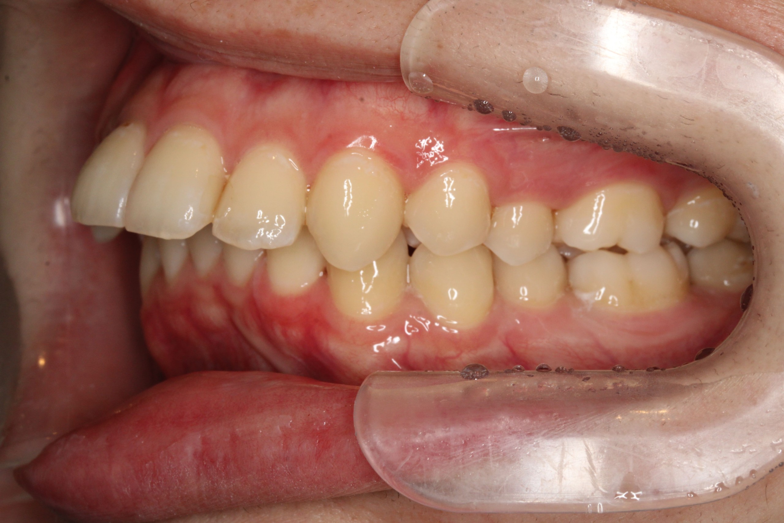 裏側矯正　上顎前突症例