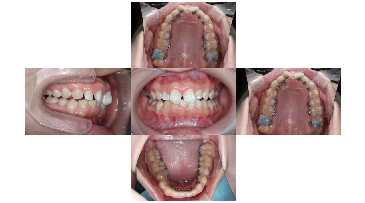 裏側矯正・過蓋咬合の症例　装置装着