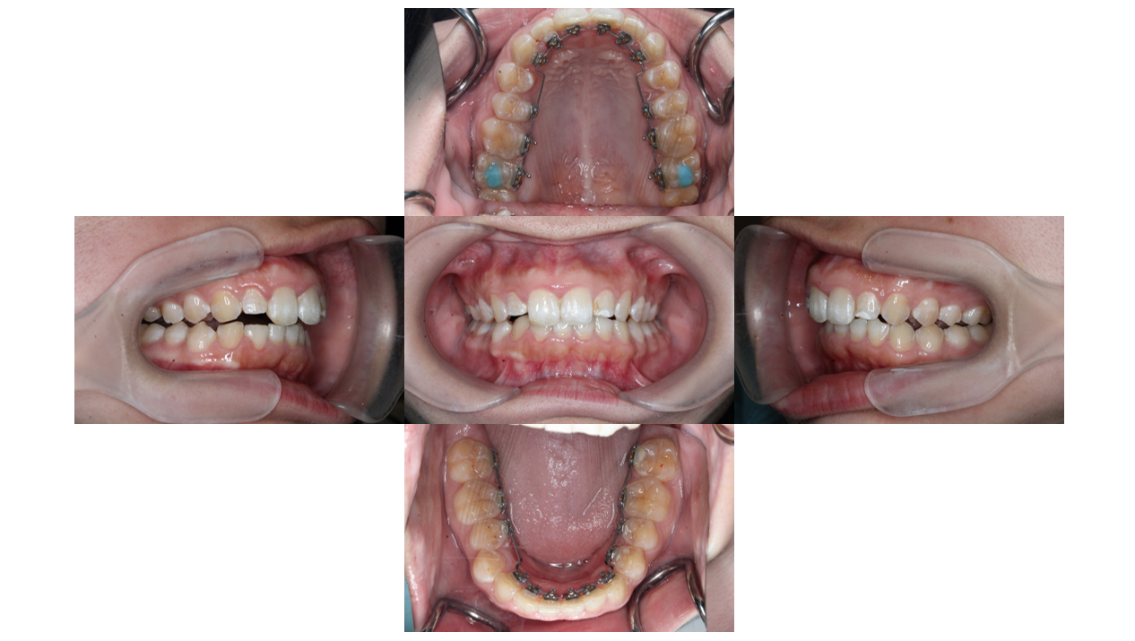 裏側矯正・過蓋咬合の症例　5ヶ月