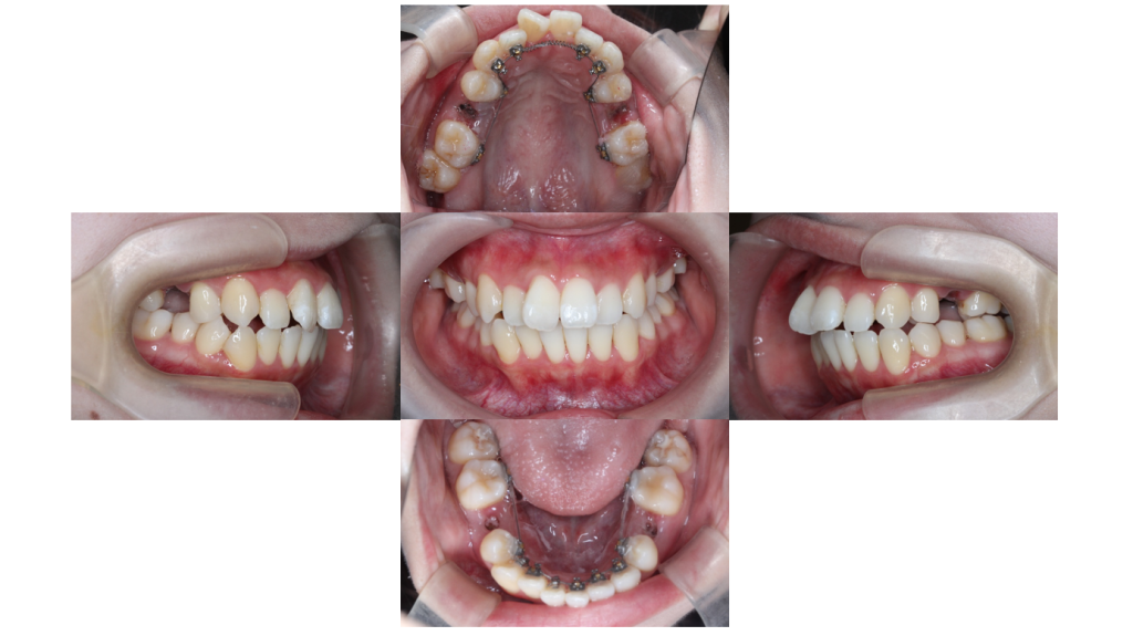 叢生・裏側全体矯正の症例