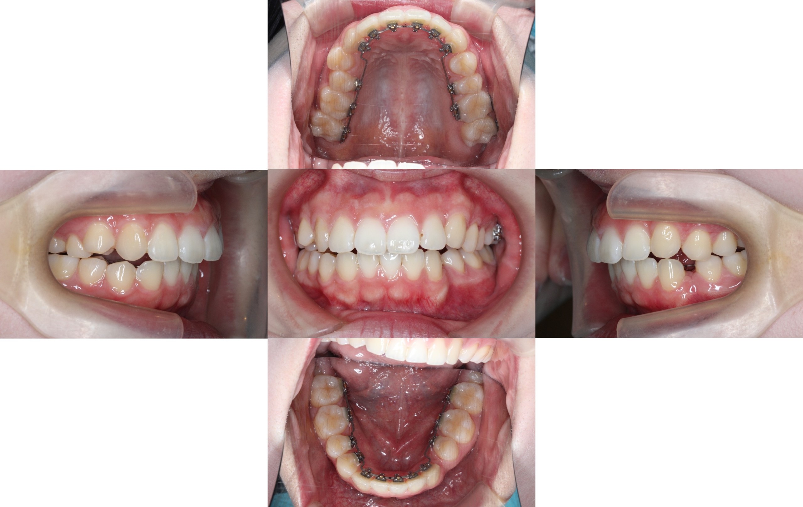 裏側矯正　上顎前突　開咬症例