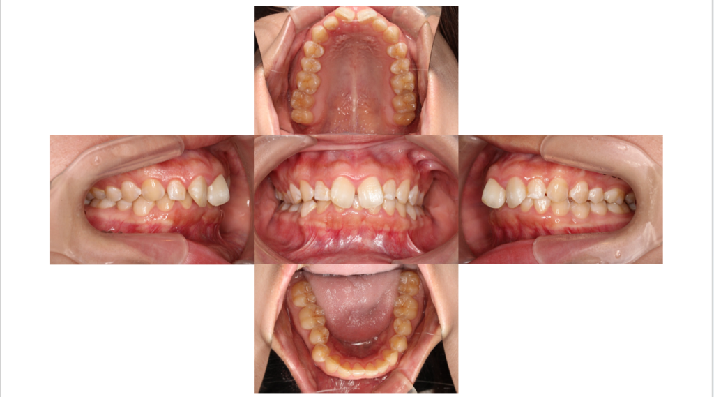 裏側矯正・過蓋咬合の症例　初診