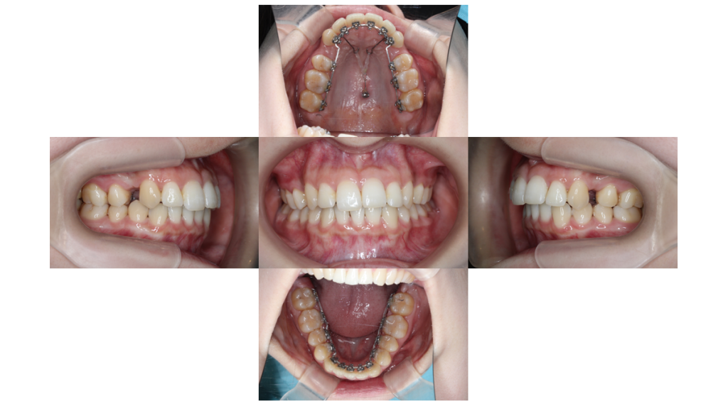 裏側矯正・叢生の症例