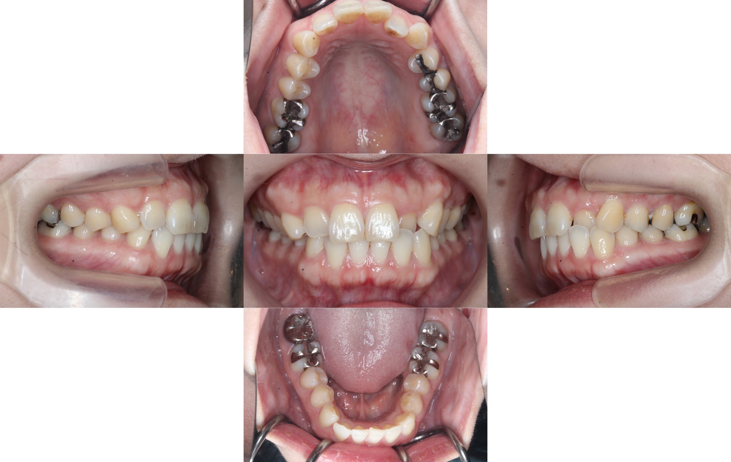 ハーフリンガル矯正　叢生症例