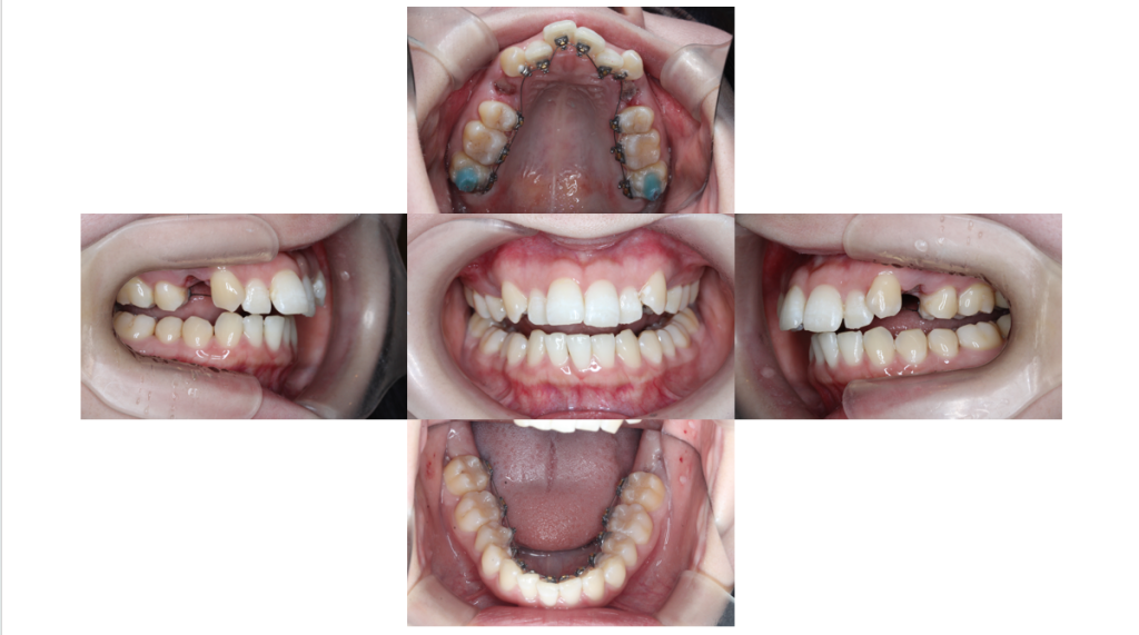 裏側矯正・叢生の症例