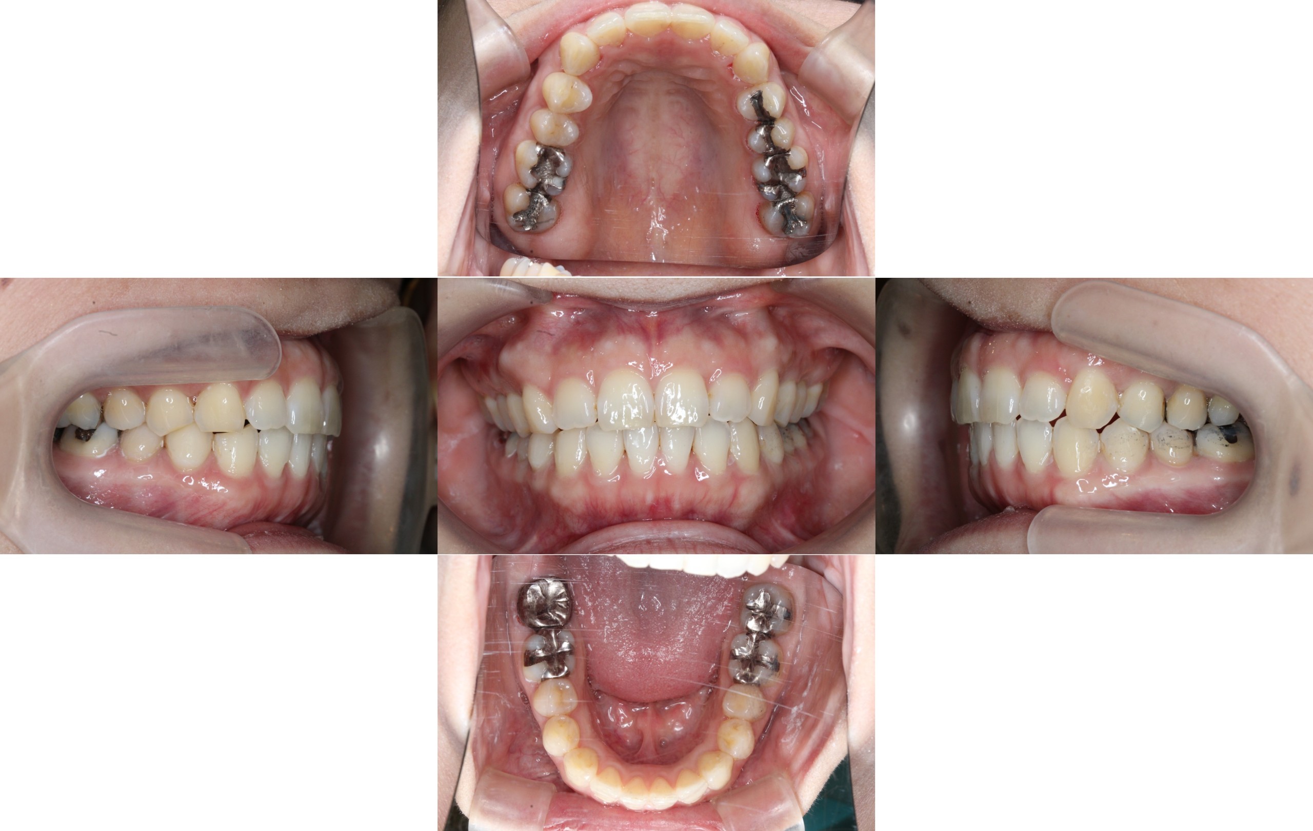 ハーフリンガル矯正　叢生症例