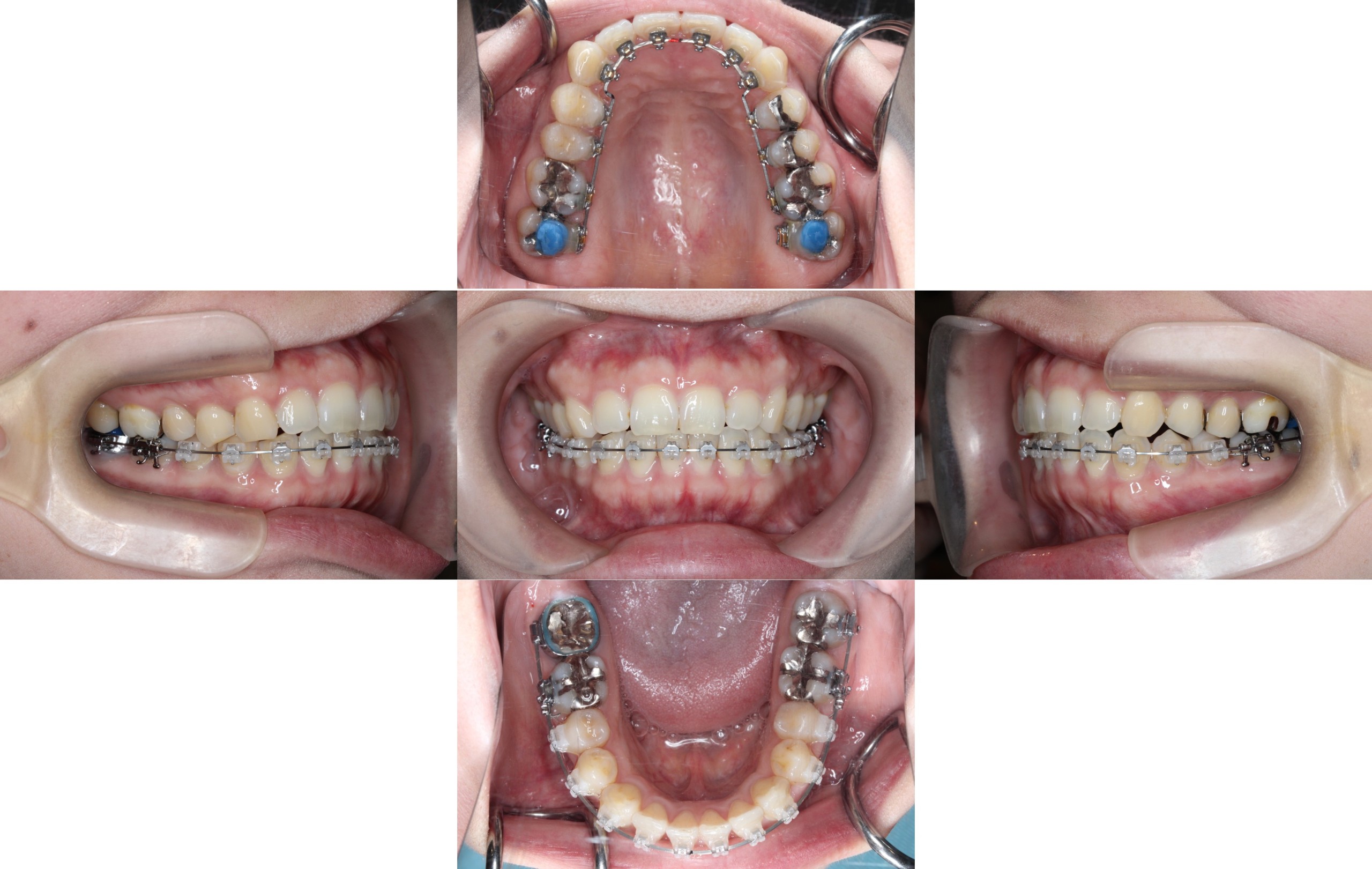 ハーフリンガル矯正　叢生症例