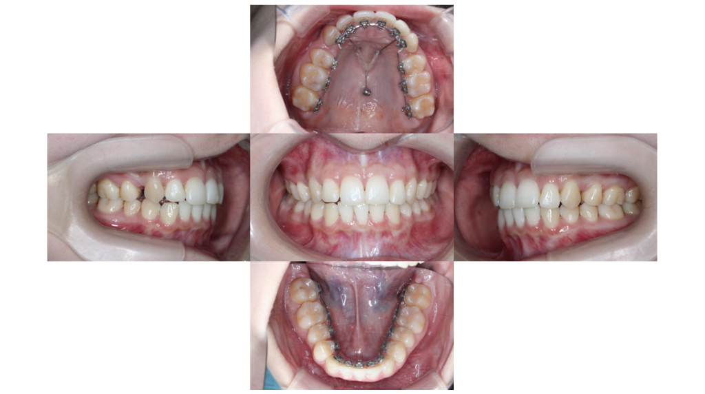 裏側矯正・叢生の症例
