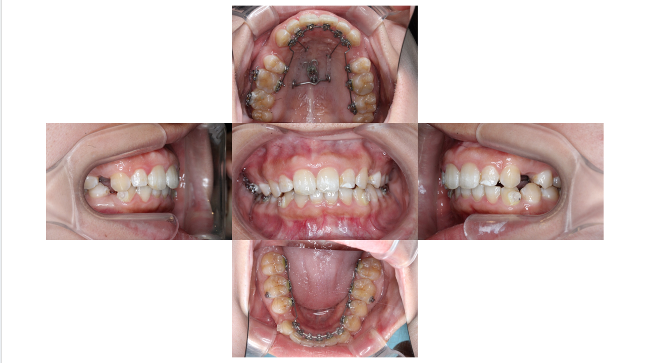裏側矯正・過蓋咬合の症例　18ヶ月