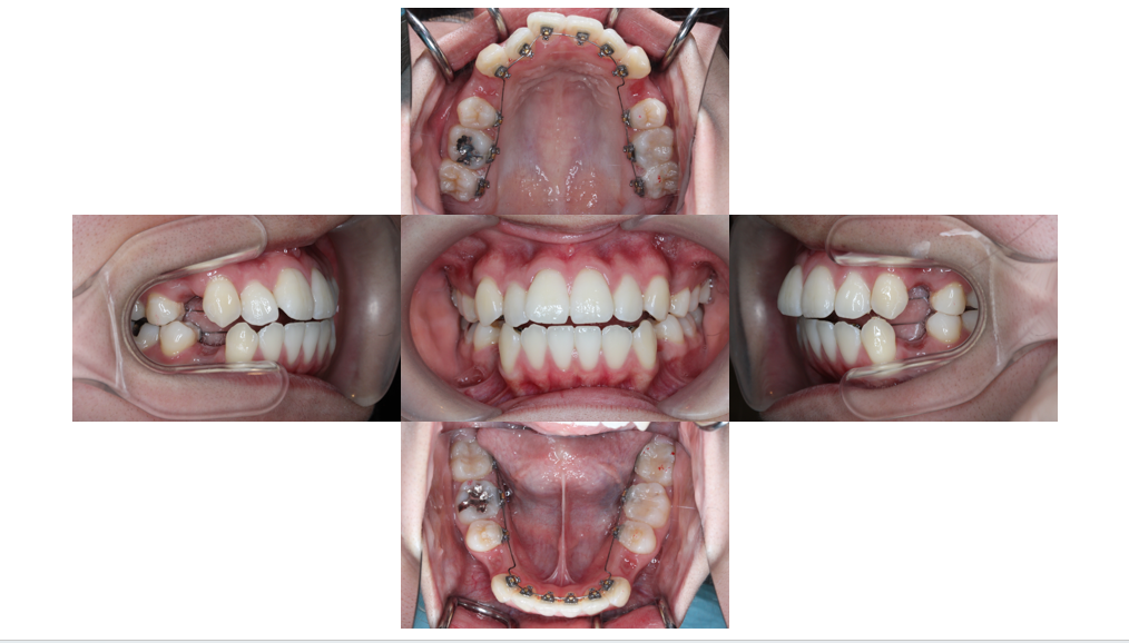 叢生・裏側矯正の症例