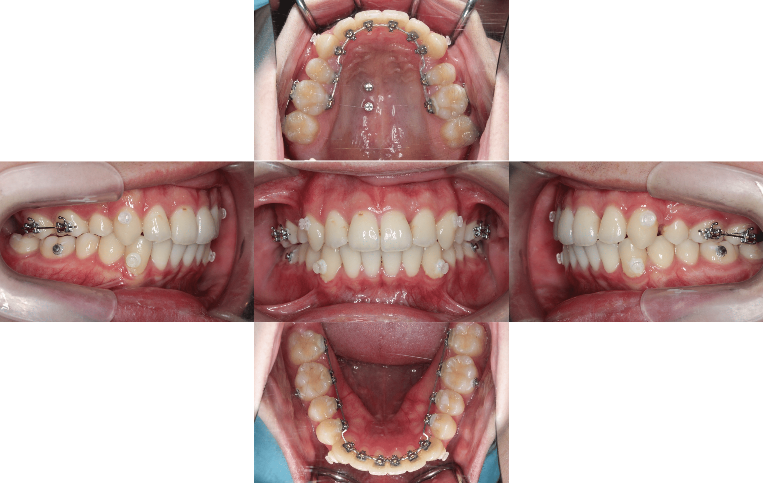 裏側矯正　上顎前突症例