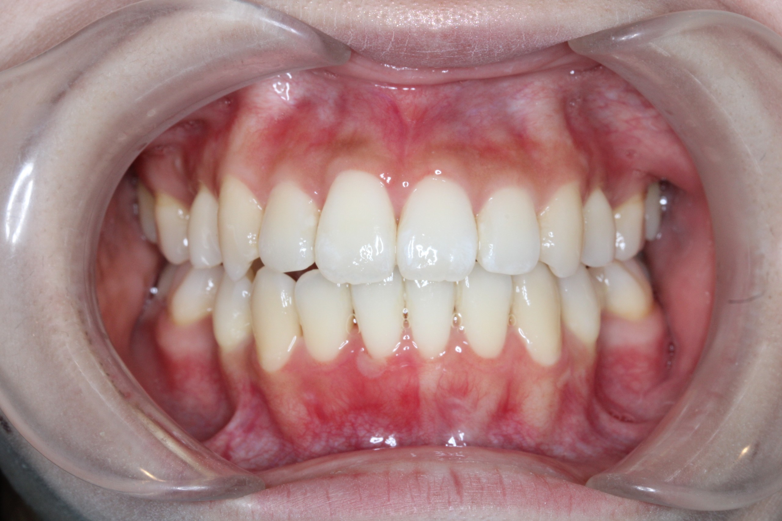 叢生・裏側全体矯正の症例