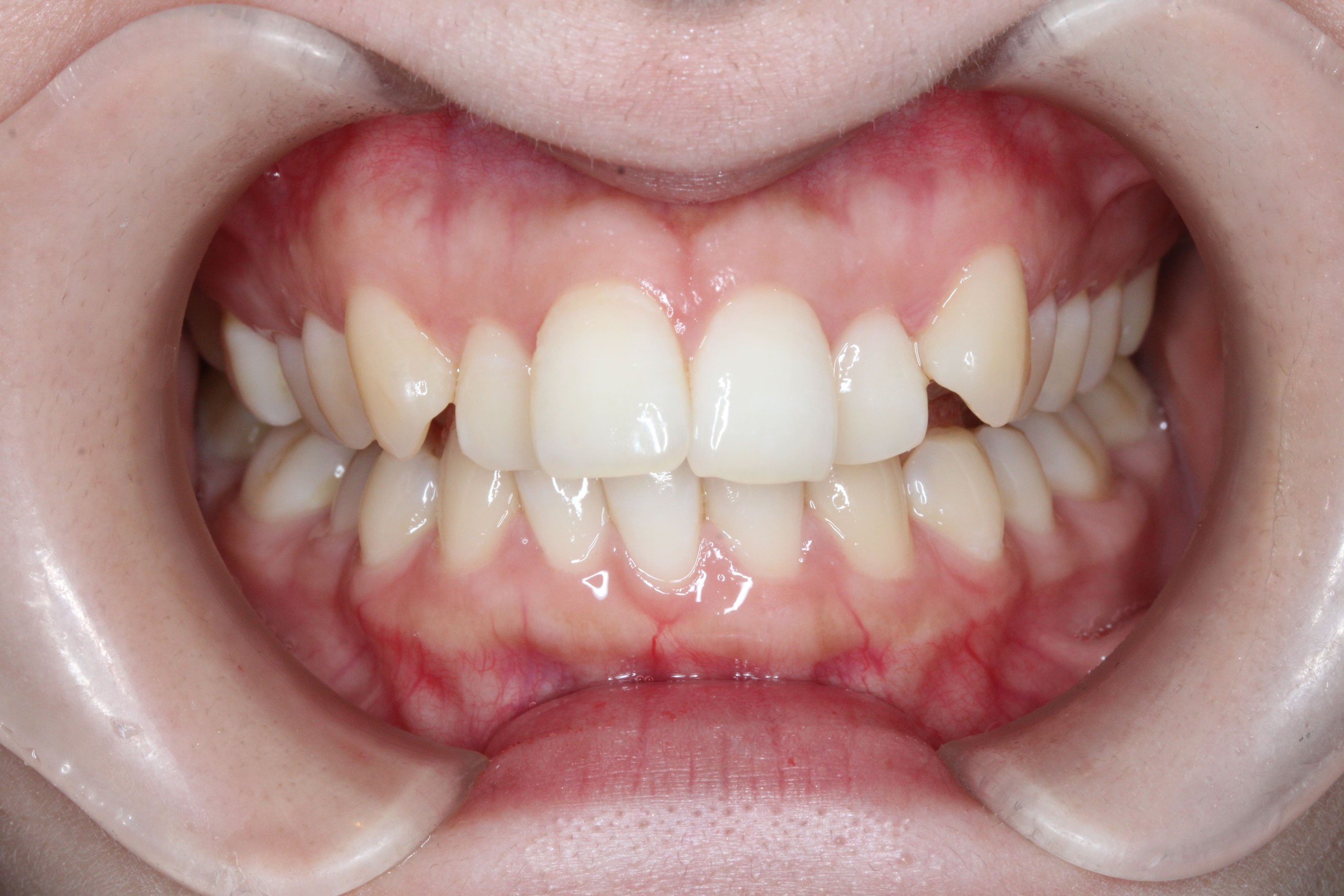 裏側矯正・叢生の症例