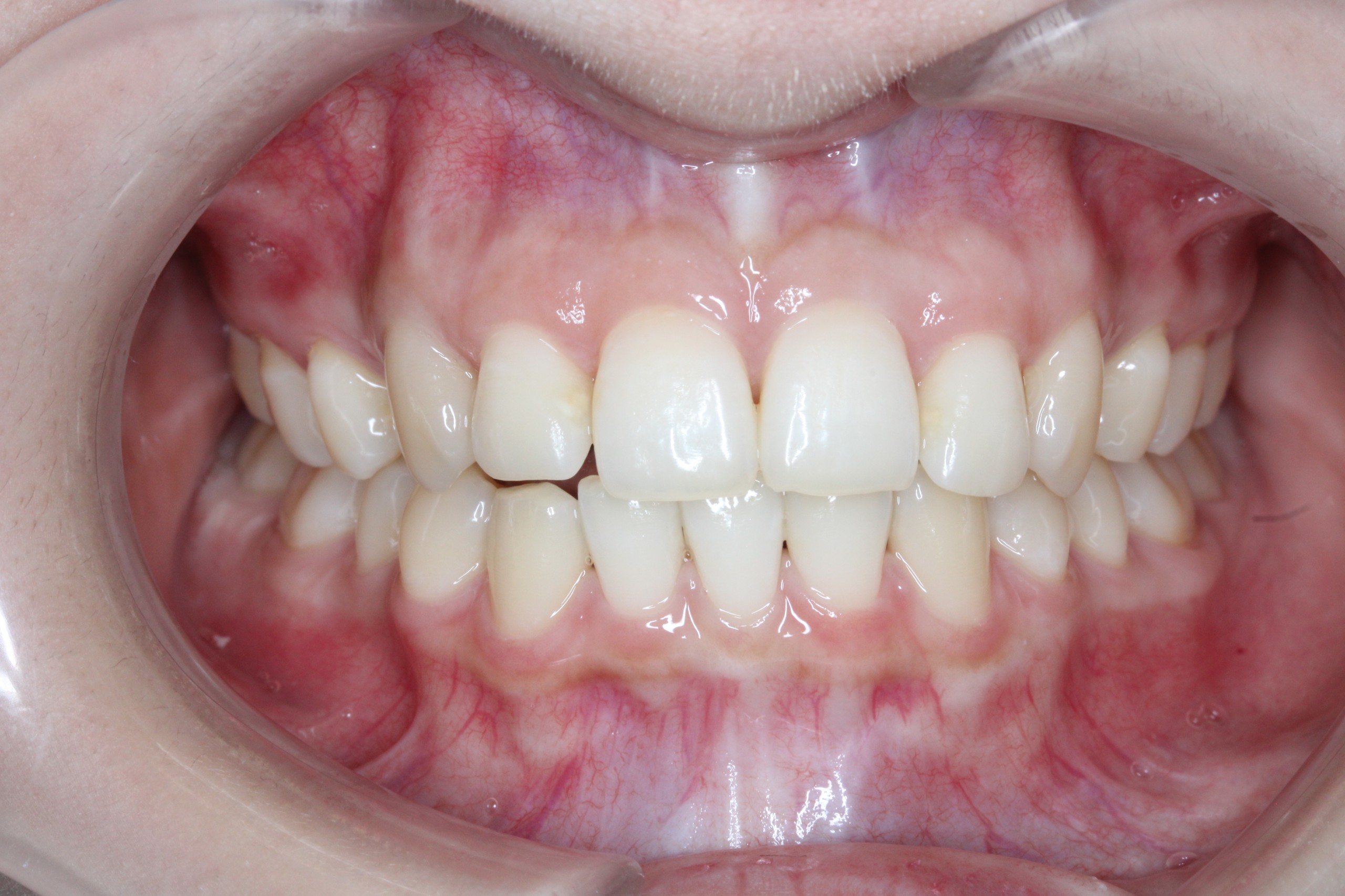 裏側矯正・叢生の症例