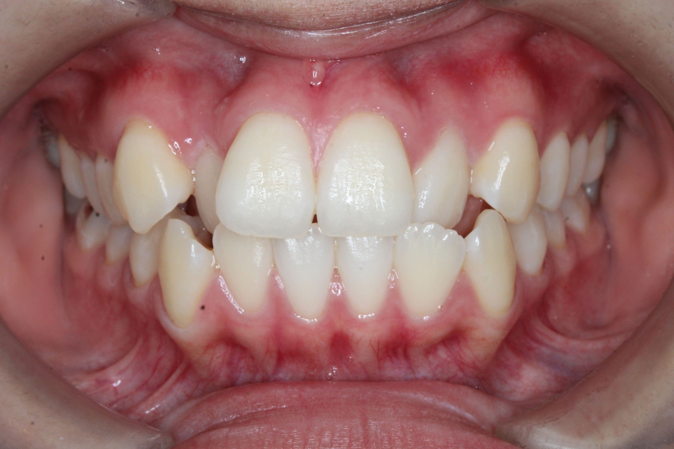 叢生・裏側矯正の症例