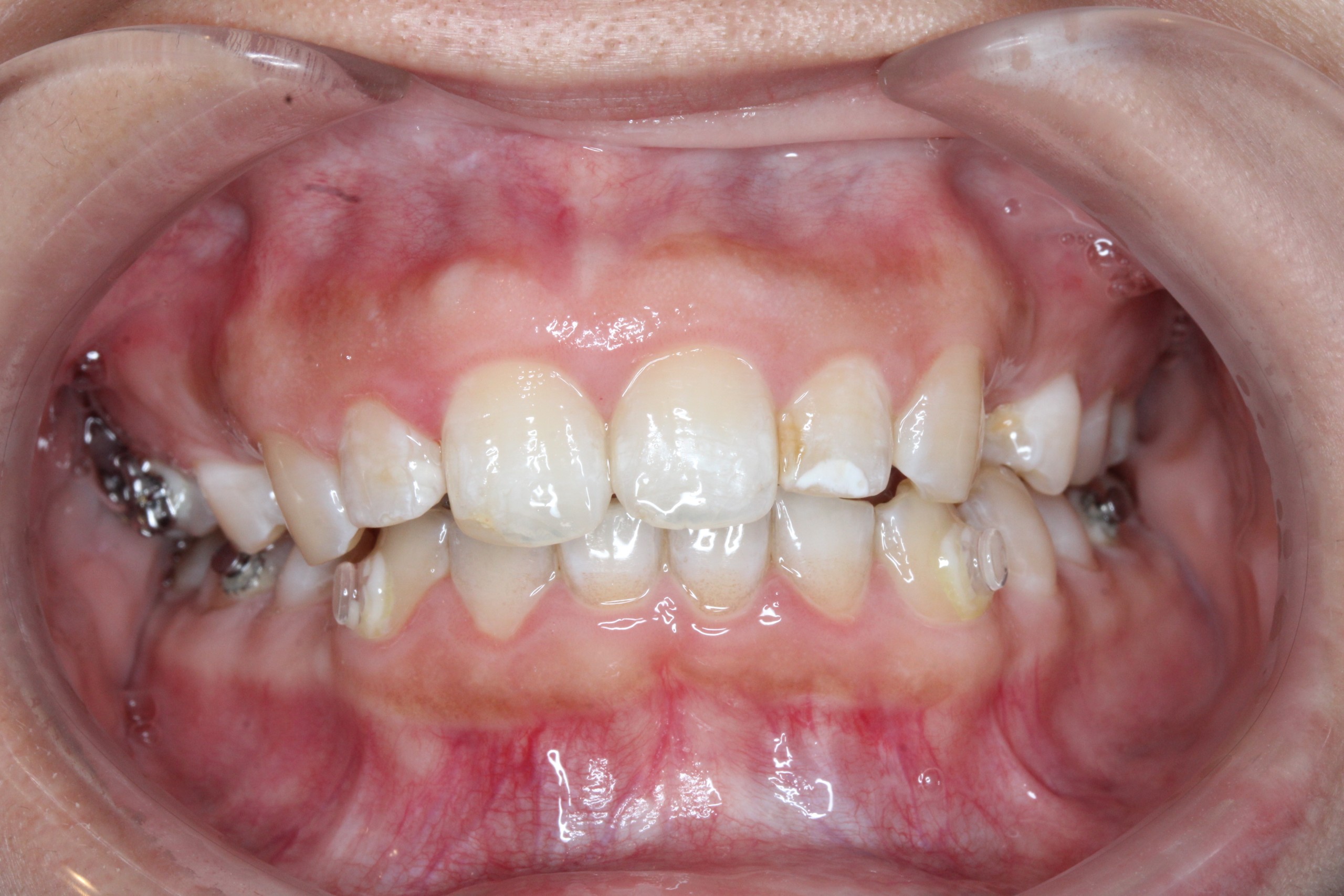 裏側矯正・過蓋咬合の症例