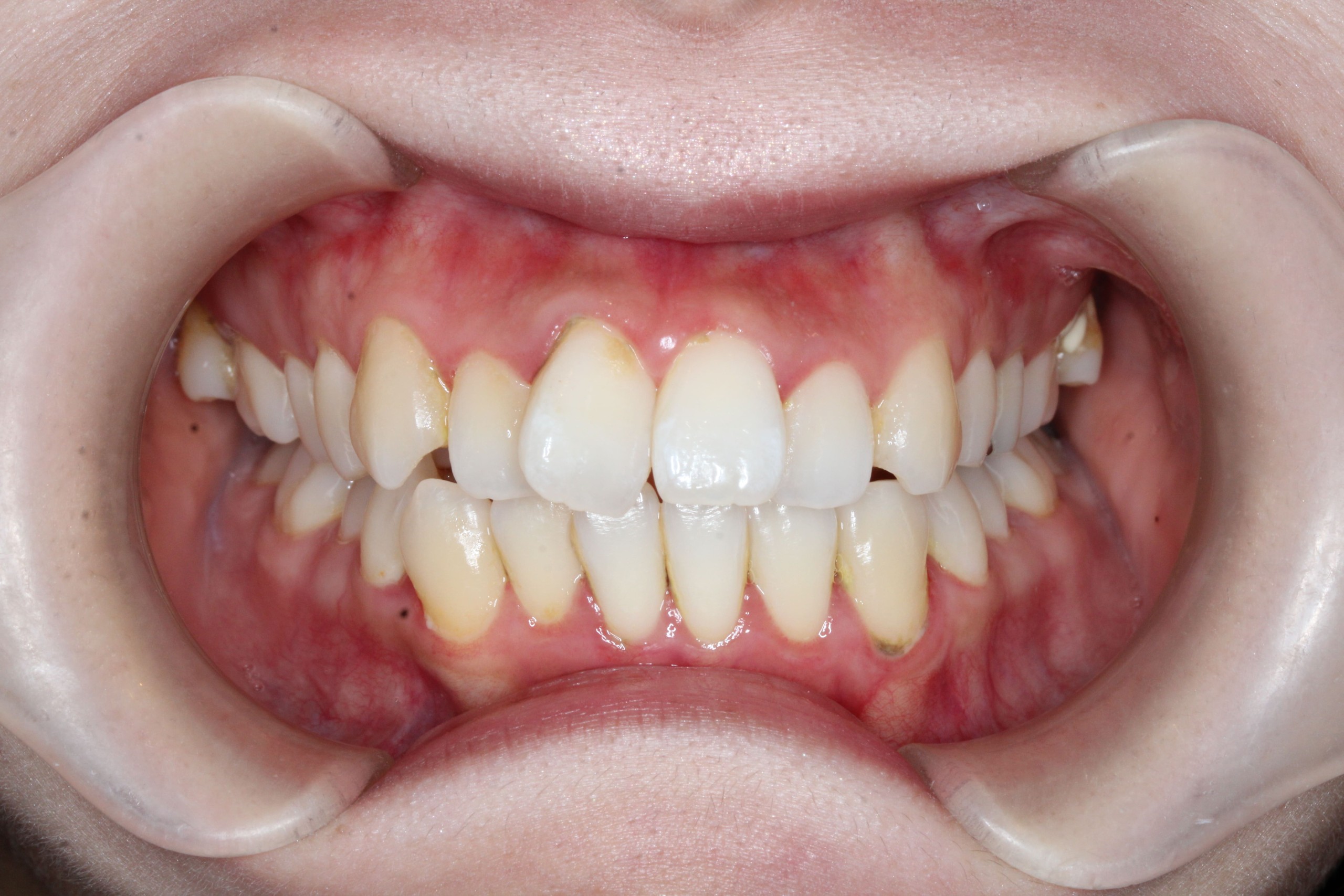 前歯のでこぼこ・裏側全体矯正の症例