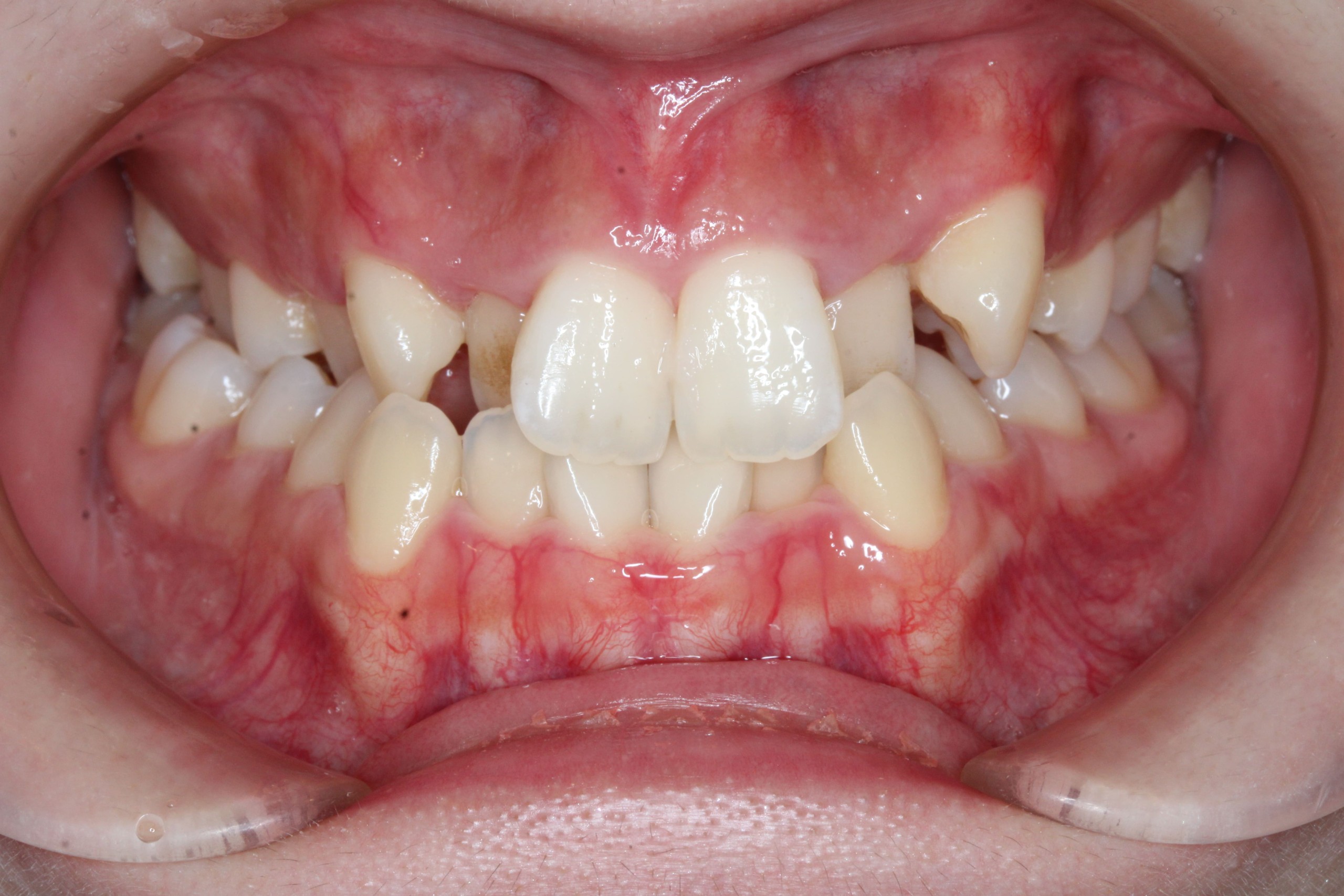 裏側矯正　叢生・下顎前突症例