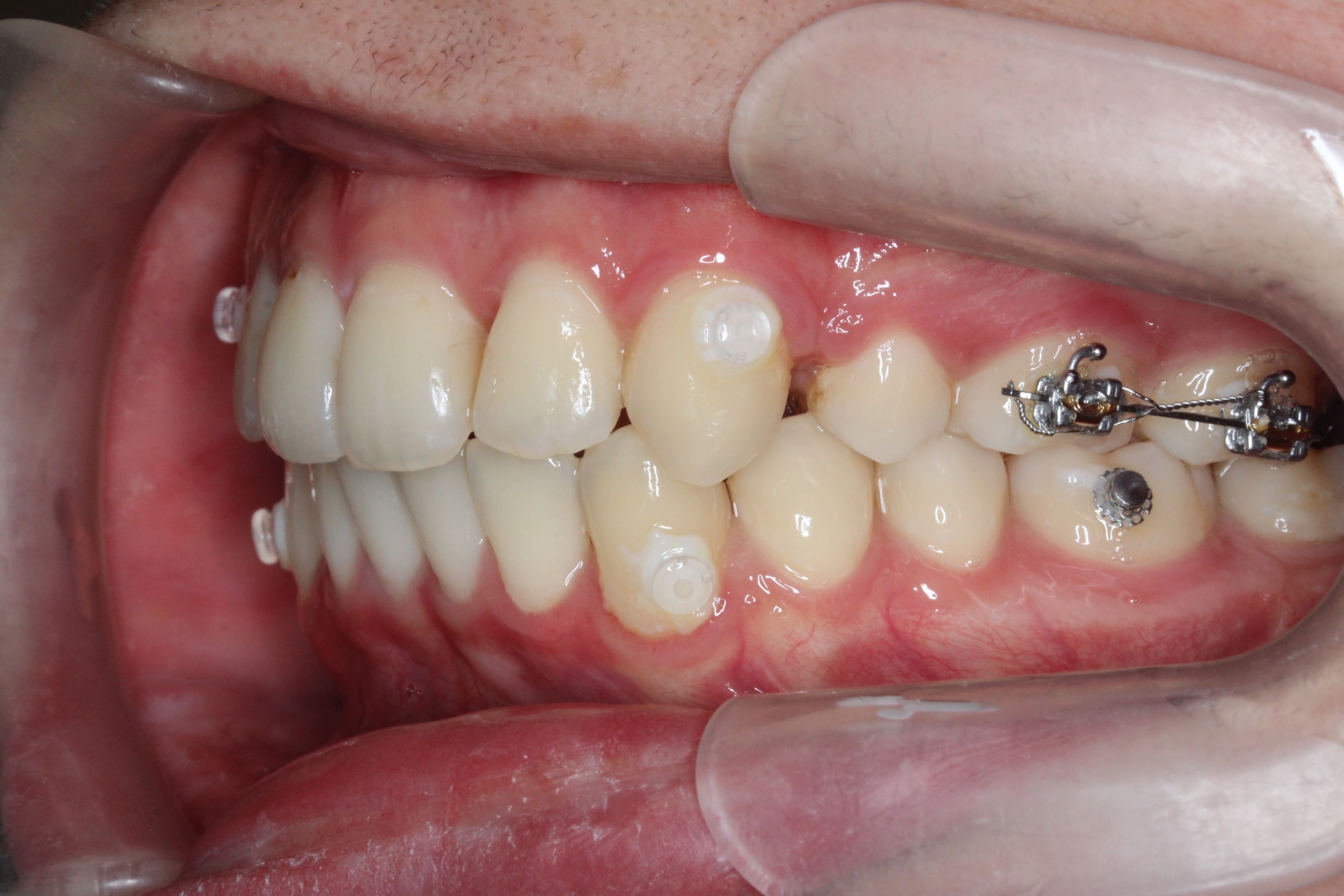 裏側矯正　上顎前突症例